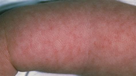 rash after meningitis vaccine
